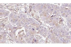 ABIN6272726 at 1/100 staining Human liver cancer tissue by IHC-P. (OR4D5 Antikörper)