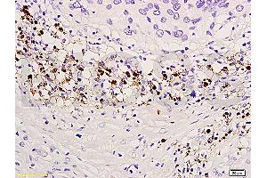 Formalin-fixed and paraffin embedded human endometrium carcinoma labeled with Anti-TIMP-4 Polyclonal Antibody, Unconjugated (ABIN668376) at 1:300, followed by conjugation to the secondary antibody and DAB staining