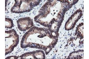 Immunohistochemical staining of paraffin-embedded Adenocarcinoma of Human colon tissue using anti-RFPL3 mouse monoclonal antibody. (RFPL3 Antikörper)