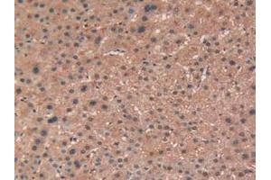 IHC-P analysis of Human Liver Cancer Tissue, with DAB staining. (TEK Antikörper  (AA 1-116))