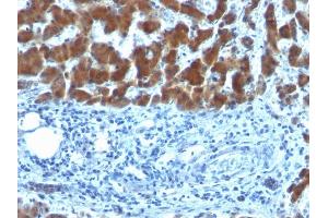 Formalin-fixed, paraffin-embedded human Hepatocellular Carcinoma stained with RBP1 (SPM442) (RBP4 Antikörper)