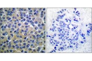 Immunohistochemistry analysis of paraffin-embedded human breast carcinoma, using SYK (Phospho-Tyr348) Antibody. (SYK Antikörper  (pTyr348))
