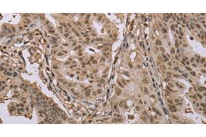 Immunohistochemistry of paraffin-embedded Human gastric cancer using CAB39 Polyclonal Antibody at dilution of 1:50 (CAB39 Antikörper)