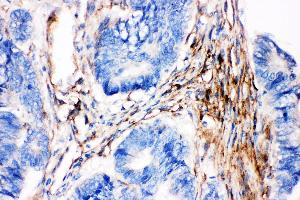 Anti- Caveolin-2 picoband antibody,IHC(P) IHC(P): Human Intestinal Cancer Tissue (Caveolin 2 Antikörper  (AA 1-162))