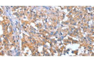 Immunohistochemistry of paraffin-embedded Human thyroid cancer tissue using NOD2 Polyclonal Antibody at dilution 1:40 (NOD2 Antikörper)