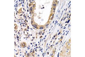 Immunohistochemistry of paraffin-embedded human stomach cancer using PTGIR antibody at dilution of 1:200 (400x lens). (Prostacyclin Receptor Antikörper)