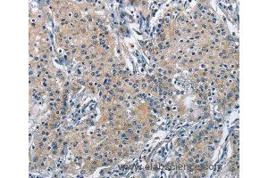 Immunohistochemistry of Human gastric cancer using TRIP4 Polyclonal Antibody at dilution of 1:50 (TRIP4 Antikörper)