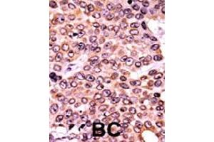 Formalin-fixed and paraffin-embedded human cancer tissue reacted with CDKN1A (phospho T145) polyclonal antibody  which was peroxidase-conjugated to the secondary antibody followed by AEC staining.