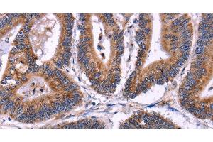 Immunohistochemistry of paraffin-embedded Human colon cancer using SIGLEC5 Polyclonal Antibody at dilution of 1:30 (SIGLEC5 Antikörper)