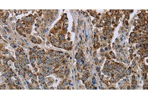 Immunohistochemistry of paraffin-embedded Human liver cancer using GOT2 Polyclonal Antibody at dilution of 1:50 (GOT2 Antikörper)