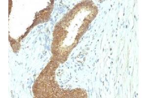 IHC testing of FFPE human colon carcinoma with Alkaline Phosphatase antibody (ALPL/597). (Alkaline Phosphatase Antikörper)