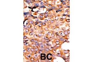 Formalin-fixed and paraffin-embedded human cancer tissue reacted with the primary antibody, which was peroxidase-conjugated to the secondary antibody, followed by AEC staining. (PANK3 Antikörper  (AA 150-181))