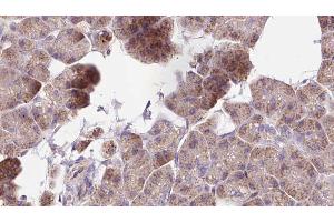 ABIN6273266 at 1/100 staining Human pancreas cancer tissue by IHC-P. (MAP1B Antikörper  (Internal Region))