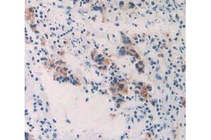 IHC-P analysis of prostate gland cancer tissue, with DAB staining.