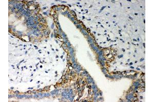 Anti- LYRIC Picoband antibody,IHC(P) IHC(P): Human Mammary Cancer Tissue