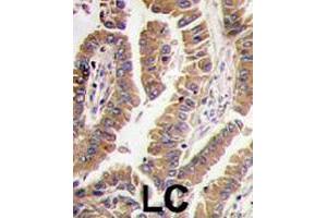 Formalin-fixed and paraffin-embedded human lung carcinoma tissue reacted with BMP4 polyclonal antibody  , which was peroxidase-conjugated to the secondary antibody, followed by DAB staining. (BMP4 Antikörper  (N-Term))