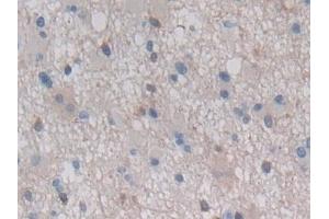 Detection of HSPb7 in Human Glioma Tissue using Polyclonal Antibody to Heat Shock Protein Beta 7 (HSPb7)