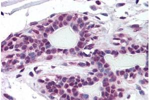 Human Breast (formalin-fixed, paraffin-embedded) stained with ZMYM2 antibody ABIN297886 at 10 ug/ml followed by biotinylated goat anti-rabbit IgG secondary antibody ABIN481713, alkaline phosphatase-streptavidin and chromogen. (ZMYM2 Antikörper  (AA 1250-1300))