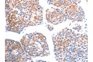The image on the left is immunohistochemistry of paraffin-embedded Human liver cancer tissue using ABIN7192492(SLC44A1 Antibody) at dilution 1/25, on the right is treated with synthetic peptide.