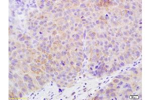 Formalin-fixed and paraffin embedded human bladder carcinoma labeled with Rabbit Anti-Claudin 17 Polyclonal Antibody, Unconjugated  at 1:200 followed by conjugation to the secondary antibody and DAB staining (Claudin 17 Antikörper  (AA 29-81))