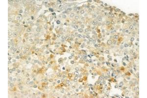 ABIN6266025 and ABIN6277652 at 1/100 staining human prostate carcinoma by IHC-P. (WHSC1L1 Antikörper  (N-Term))