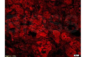 Formalin-fixed and paraffin-embedded: Human nasopharyngeal carcinoma labeled with Rabbit Anti-BAFF/CD257 Polyclonal Antibody, Unconjugated (ABIN740175) 1:400 followed by conjugation to the secondary antibody and DAB staining (BAFF Antikörper  (AA 221-309))