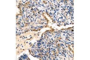 Immunohistochemistry analysis of paraffin embedded human lung cancer using syt1 (ABIN7075794) at dilution of 1: 2000