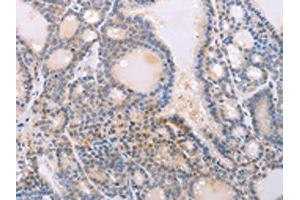 The image on the left is immunohistochemistry of paraffin-embedded Human thyroid cancer tissue using ABIN7130592(PFN4 Antibody) at dilution 1/20, on the right is treated with fusion protein. (Profilin 4 Antikörper)