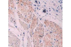 IHC-P analysis of stomach cancer tissue, with DAB staining. (Supervillin Antikörper  (AA 1385-1525))