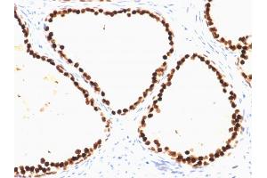 Formalin-fixed, paraffin-embedded human Prostate Carcinoma stained with FOXA1 Mouse Monoclonal Antibody (FOXA1/1515). (FOXA1 Antikörper  (AA 372-472))