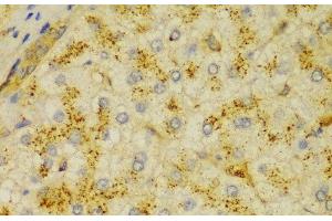 Immunohistochemistry of paraffin-embedded Human liver cancer using ACTN1 Polyclonal Antibody at dilution of 1:100 (40x lens). (ACTN1 Antikörper)