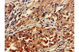 Immunohistochemistry of paraffin-embedded human lung cancer using ABIN7154711 at dilution of 1:100 (GNAT1 Antikörper  (AA 92-170))