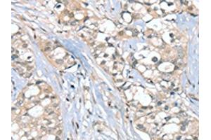 The image on the left is immunohistochemistry of paraffin-embedded Human breast cancer tissue using ABIN7192347(SGPL1 Antibody) at dilution 1/25, on the right is treated with synthetic peptide. (SGPL1 Antikörper)