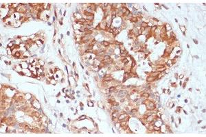 Immunohistochemistry of paraffin-embedded Human mammary cancer using PTPRN2 Polyclonal Antibody at dilution of 1:100 (40x lens). (PTPRN2 Antikörper)