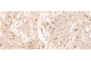Immunohistochemistry of paraffin-embedded Human esophagus cancer tissue using IL7 Polyclonal Antibody at dilution of 1:30(x200) (IL-7 Antikörper)