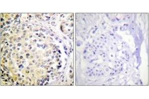 Immunohistochemistry analysis of paraffin-embedded human breast carcinoma tissue, using Vimentin (Ab-56) Antibody. (Vimentin Antikörper  (AA 31-80))