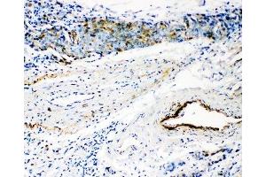 IHC-P: HYAL3 antibody testing of human breast cancer tissue (HYAL3 Antikörper  (C-Term))