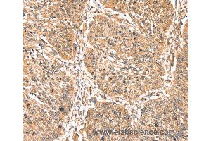 Immunohistochemistry of Human lung cancer using PDLIM4 Polyclonal Antibody at dilution of 1:40 (PDLIM4 Antikörper)