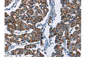 IHC analysis of paraffin-embedded human breast cancer tissue, using HINT2 antibody (1/50 dilution, 200X magnification). (HINT2 Antikörper)