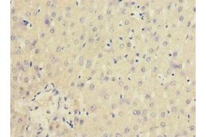 Immunohistochemistry of paraffin-embedded human liver cancer using ABIN7156847 at dilution of 1:100 (CD25 Antikörper  (AA 30-250))
