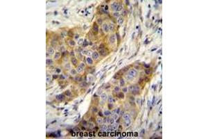 ANR39 Antibody (C-term) immunohistochemistry analysis in formalin fixed and paraffin embedded human breast carcinoma followed by peroxidase conjugation of the secondary antibody and DAB staining.
