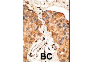 Formalin-fixed and paraffin-embedded human cancer tissue reacted with the primary antibody, which was peroxidase-conjugated to the secondary antibody, followed by DAB staining. (Neuregulin 1 Antikörper  (AA 198-229))