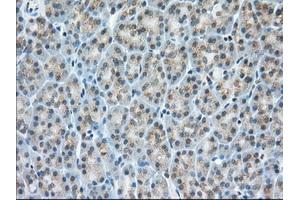 Immunohistochemical staining of paraffin-embedded Adenocarcinoma of Human colon tissue using anti-MIOX mouse monoclonal antibody. (MIOX Antikörper)