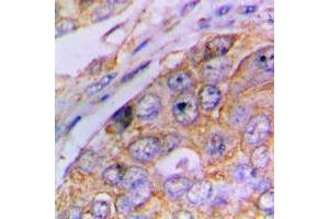 Immunohistochemical analysis of Caspase 4 p20 staining in human lung cancer formalin fixed paraffin embedded tissue section. (Caspase 4 p20 (Center) Antikörper)