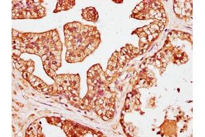 IHC image of ABIN7146454 diluted at 1:200 and staining in paraffin-embedded human prostate cancer performed on a Leica BondTM system. (Calcyphosine Antikörper  (AA 1-189))