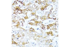 Immunohistochemistry of paraffin-embedded human liver cancer using Alpha-1 Antichymotrypsin (Alpha-1 Antichymotrypsin (SERPIN)) antibody (ABIN3016733, ABIN3016734, ABIN3016735 and ABIN6219829) at dilution of 1:100 (40x lens). (SERPINA3 Antikörper  (AA 24-423))
