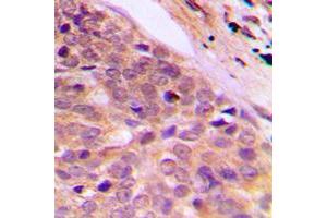Immunohistochemical analysis of Kanadaptin staining in human breast cancer formalin fixed paraffin embedded tissue section. (NADAP Antikörper  (Center))