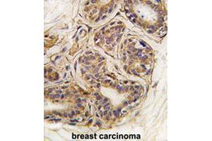 Formalin-fixed and paraffin-embedded human breast carcinomareacted with CASC3 (phospho Y181) polyclonal antibody , which was peroxidase-conjugated to the secondary antibody, followed by AEC staining.
