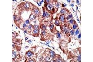 IHC analysis of FFPE human hepatocarcinoma tissue stained with the p62 antibody (SQSTM1 Antikörper  (AA 317-346))