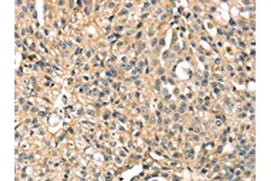 The image on the left is immunohistochemistry of paraffin-embedded Human breast cancer tissue using ABIN7131243(STX8 Antibody) at dilution 1/35, on the right is treated with fusion protein. (STX8 Antikörper)